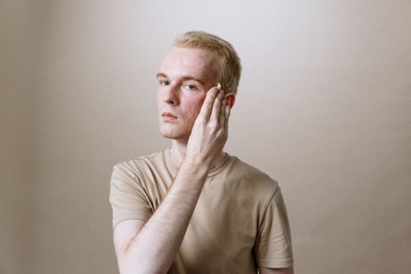 collagen benefits for acne